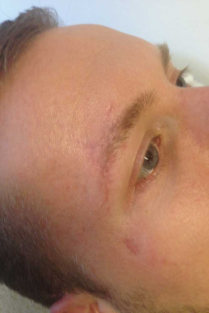 acne littekens laser