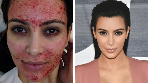 PRP platelet Rich Plasma