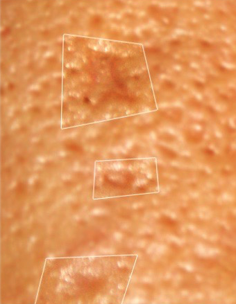 Boxcar acne littekens