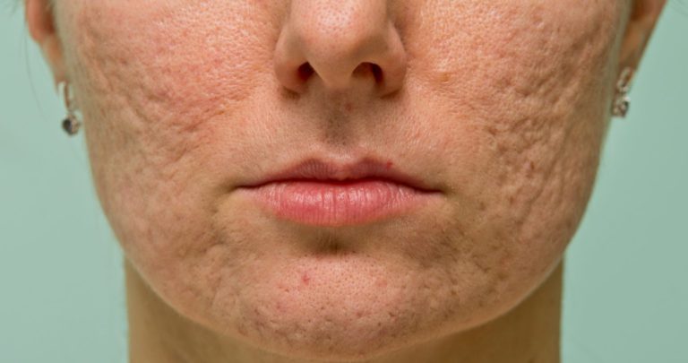 Ongeldig Luiheid geloof Behandeling van acne-littekens - De Huidkliniek