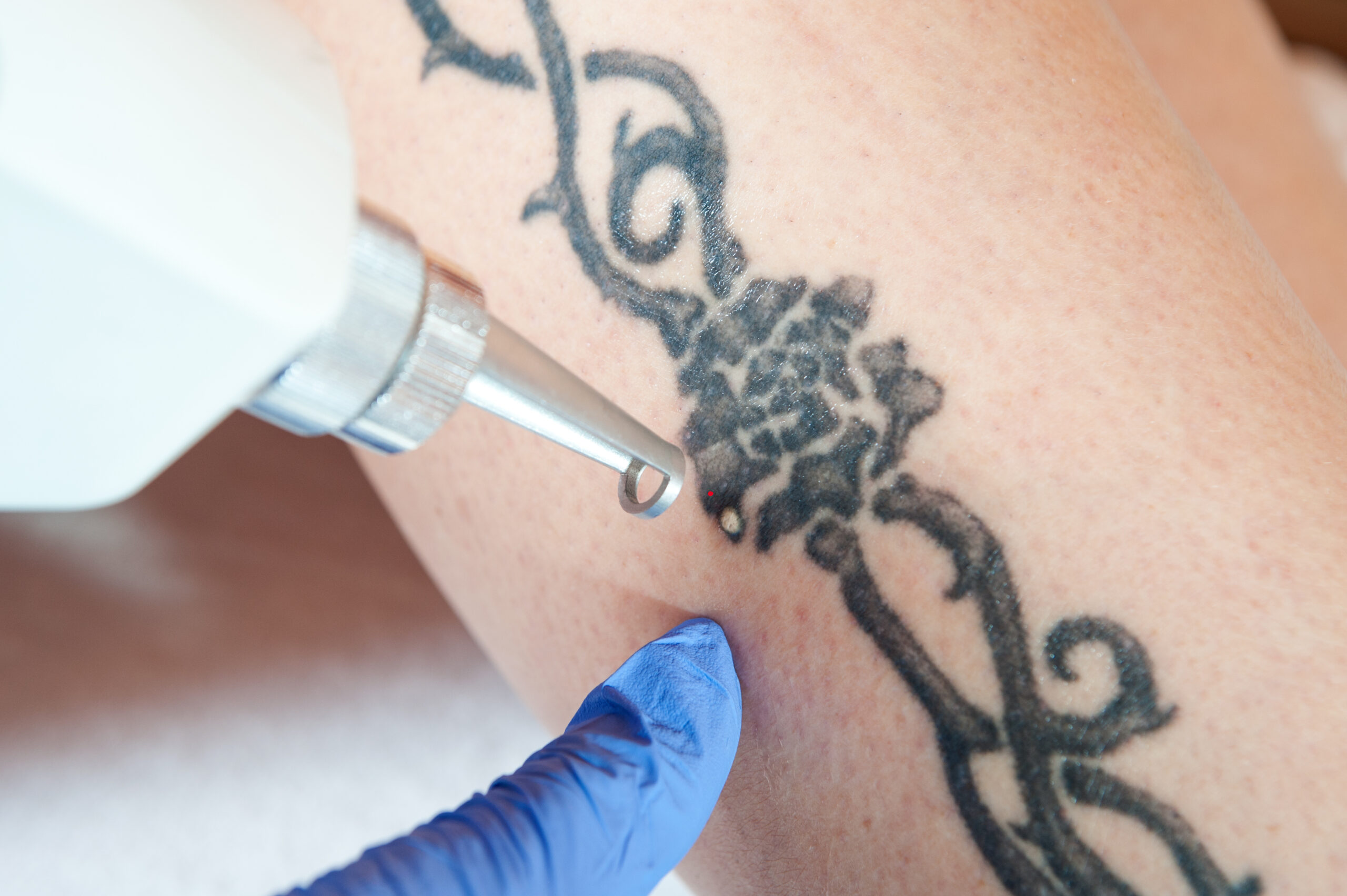 Tattoo verwijderen Koksijde Tattoo verwijderen Veurne Tattoo verwijderen oostduinkerke permanente make-up verwijderen laser
