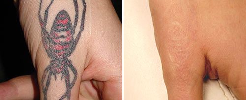 tatoeage verwijderen tattoo verwijderen Belgie
