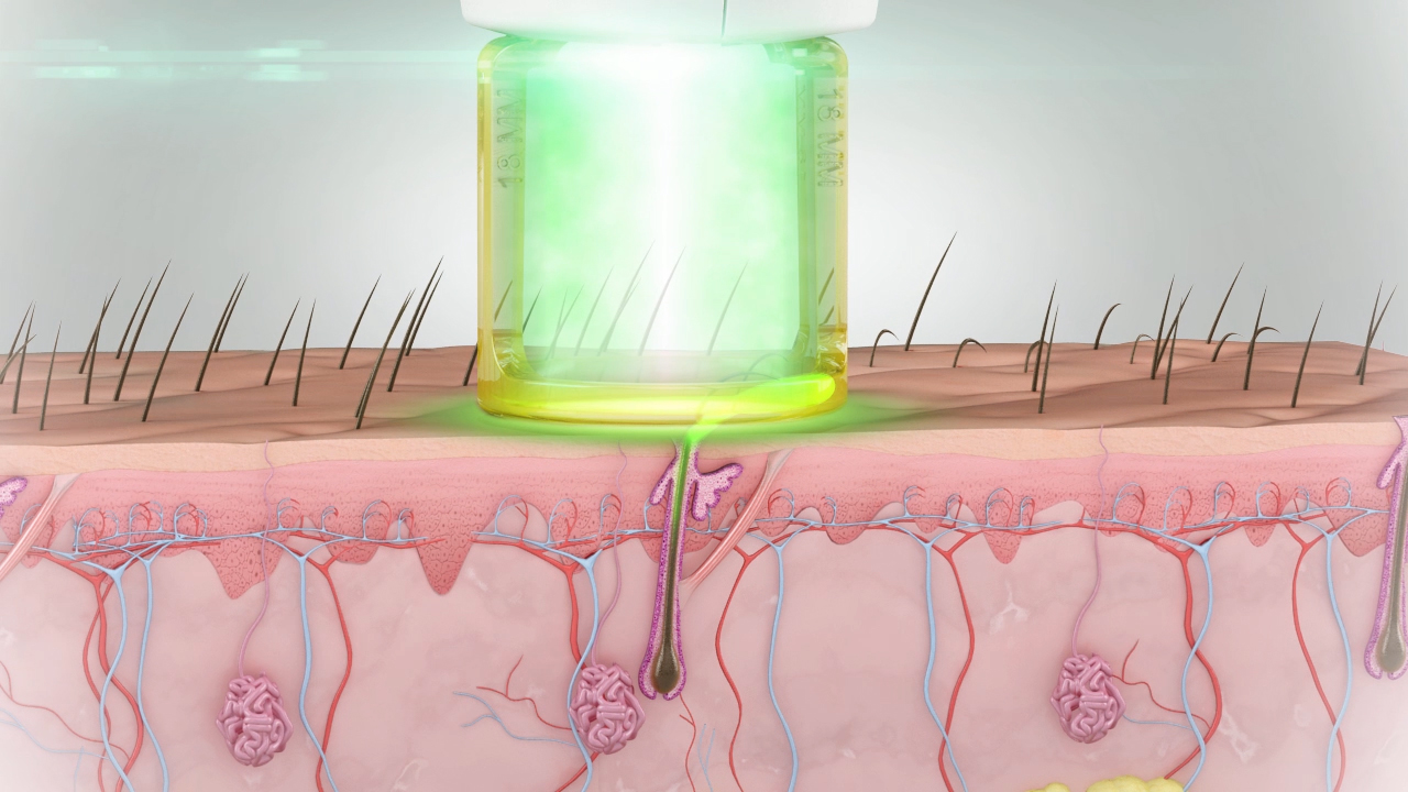 Blijven Haren Altijd Weg Na Laserontharing? - Laserontharing Hasselt, Genk - SoCleanClinic.be thumbnail